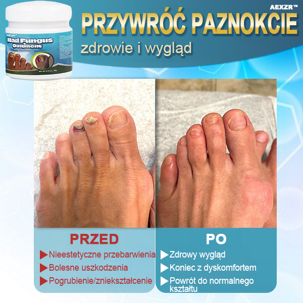 ✨Aexzr™ 5X Szybko leczący grzybicę paznokci Ointment👨🏼⚕️British Zatwierdzony przez dermatologa