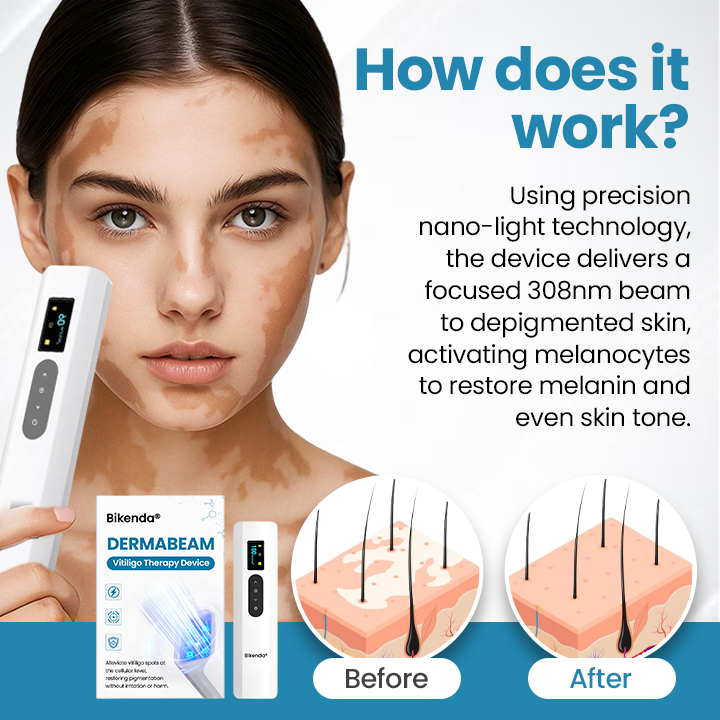 Bikenda® DermaBeam – Urządzenie do Terapii Bielactwa