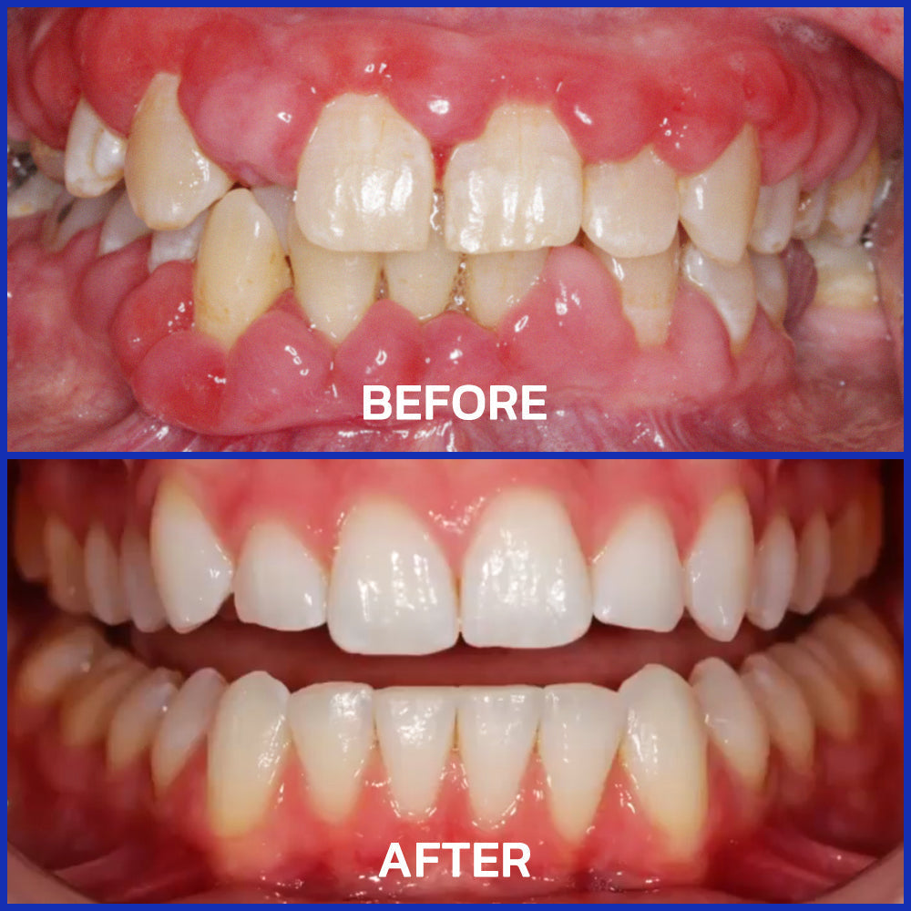 🥇Oficjalny sklep Furzero™ Focussmile Bee Venom Treatment Oral Powder 🦷 (zalecany przez ADA)