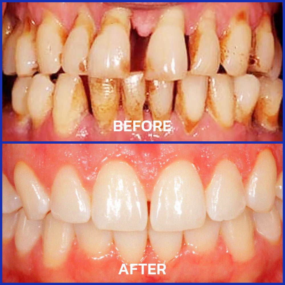 🥇Oficjalny sklep Furzero™ Focussmile Bee Venom Treatment Oral Powder 🦷 (zalecany przez ADA)