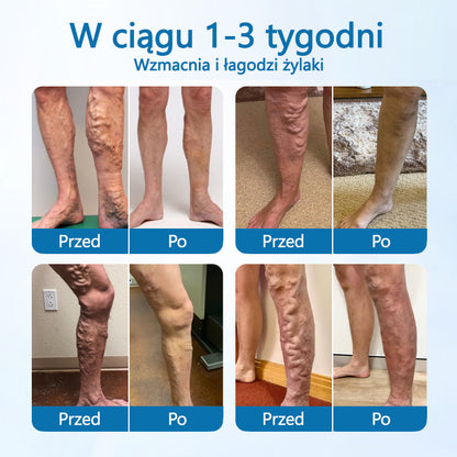 Timilk® VeinGuard – Ziołowy Spray na Żylaki z Potwierdzoną Skutecznością w 7 Dni!🌿