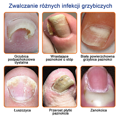 🐝🐝Furzero™ Bienengift Nagelpilz Leczenie: Całkowite rozwiązanie problemu grzybicy paznokci🌟👣