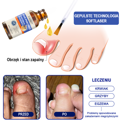 🐝🐝Furzero™ Bienengift Nagelpilz Leczenie: Całkowite rozwiązanie problemu grzybicy paznokci🌟👣